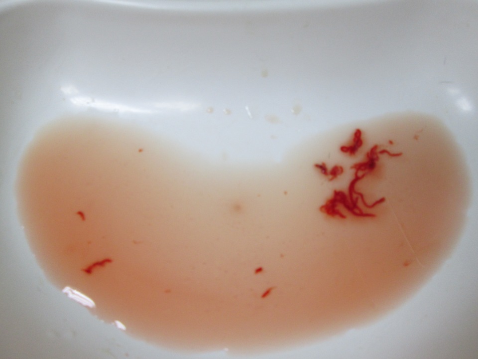 кровь и куски слизистой мочевого пузыря
